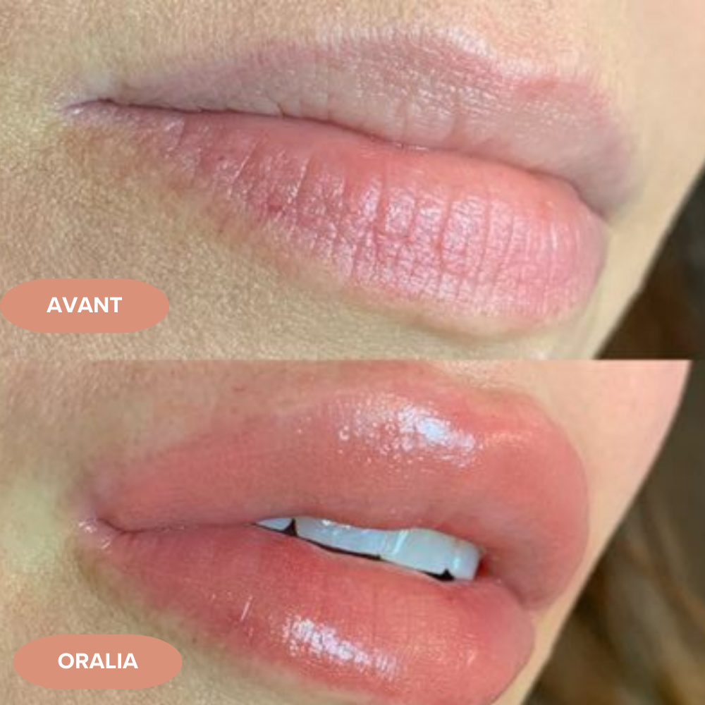 Lip plumper Oralia