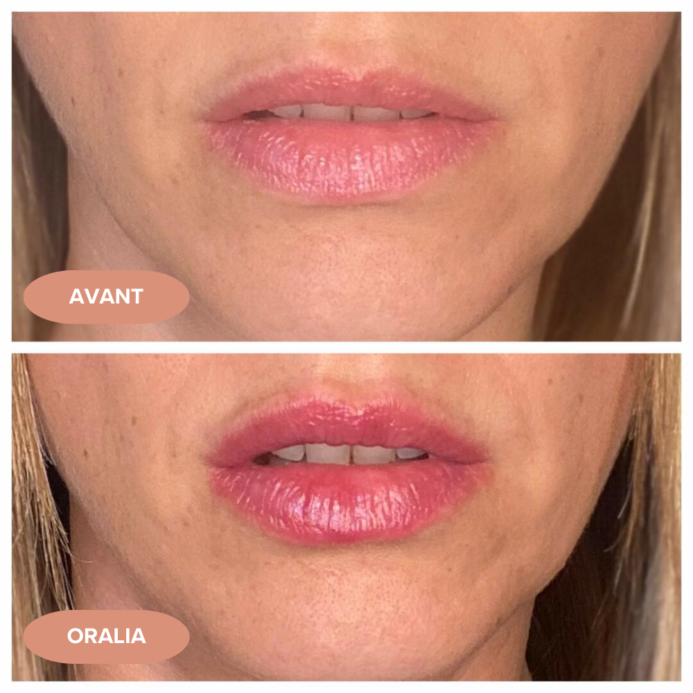 Lip plumper Oralia